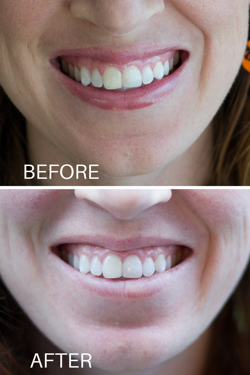 Smile Brilliant Teeth Whitening